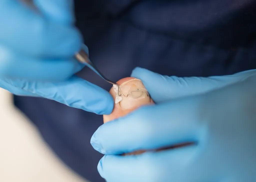 Nahaufnahme einer Nagelspange am großen Zeh mit podologischem Instrument