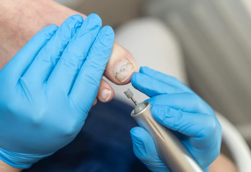 orthonyxiespangentechnik nach ross fraser