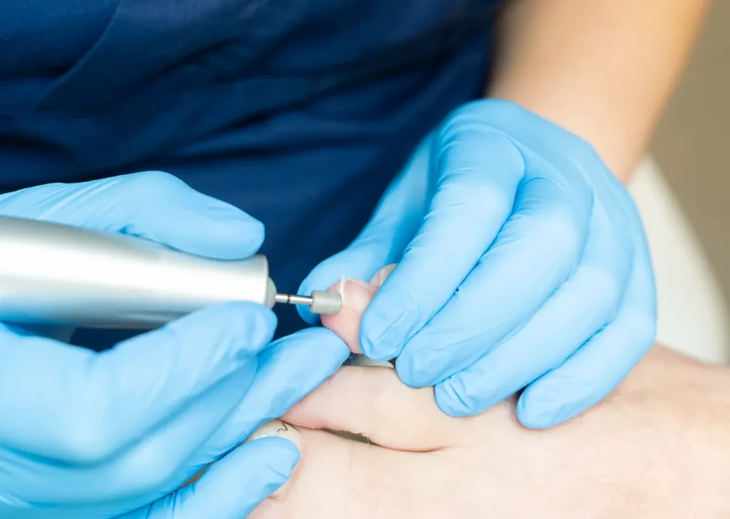 Podologin behandelt einen Zehennagel mit Fräser in Nahaufnahme